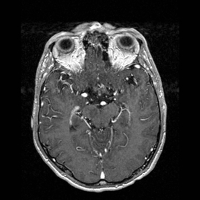 Central-variant posterior reversible encephalopathy syndrome (PRES) (Radiopaedia 43880-47358 Axial T1 C+ 64).jpg