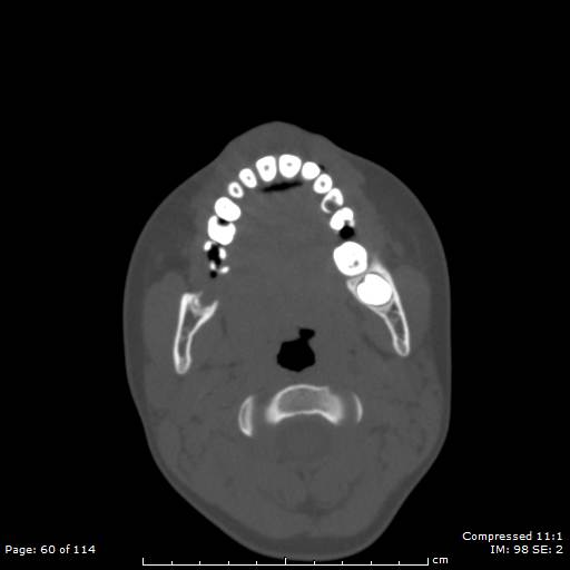 File:Central giant cell granuloma (Radiopaedia 45612-49754 Axial bone window 30).jpg