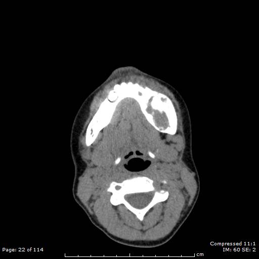 Central giant cell granuloma (Radiopaedia 45612-49754 Axial non-contrast 11).jpg