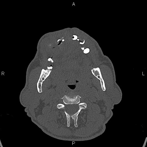 File:Central giant cell granuloma (Radiopaedia 83346-97761 Axial bone window 7).jpg