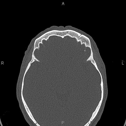 File:Central giant cell granuloma (Radiopaedia 83346-97761 Axial bone window 73).jpg