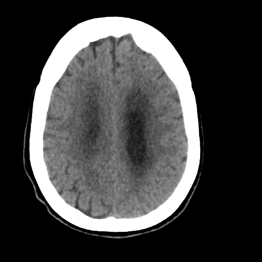 Central neurocytoma (Radiopaedia 65317-74346 Axial non-contrast 36).png