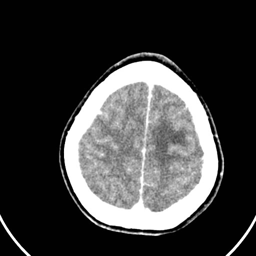 Central neurocytoma (Radiopaedia 84497-99871 B 42).jpg