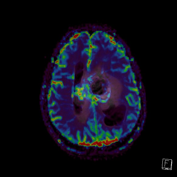 Central neurocytoma (Radiopaedia 84497-99872 Axial Perfusion 104).jpg