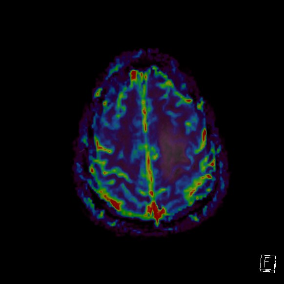 Central neurocytoma (Radiopaedia 84497-99872 Axial Perfusion 55).jpg