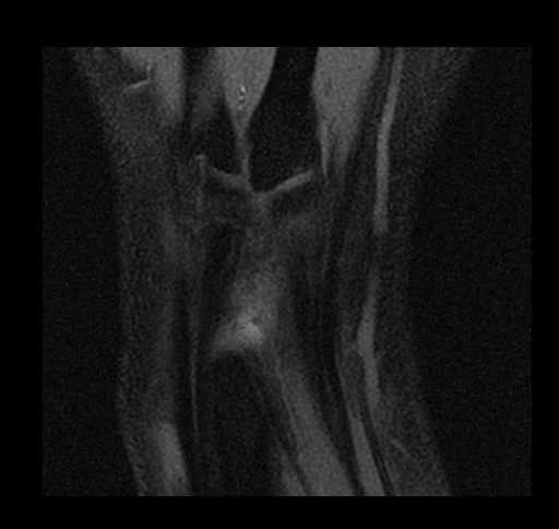 File:Central triangular fibrocartilage perforation (Radiopaedia 73346-84130 Coronal T1 fat sat 2).jpg