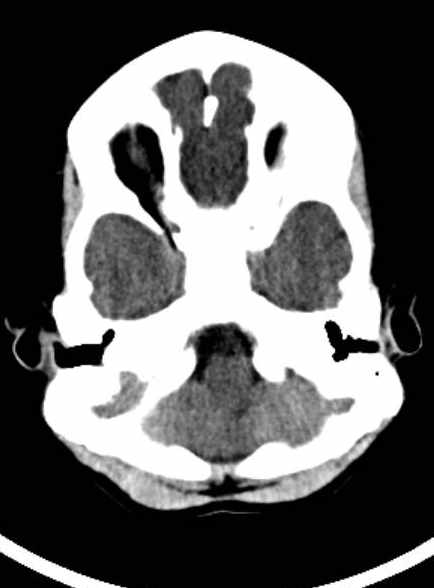 Cerebellar abscess (Radiopaedia 73727-84527 Axial non-contrast 25).jpg