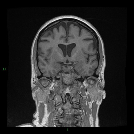 Cerebellar abscess (Radiopaedia 78135-90678 Coronal T1 C+ 70).jpg