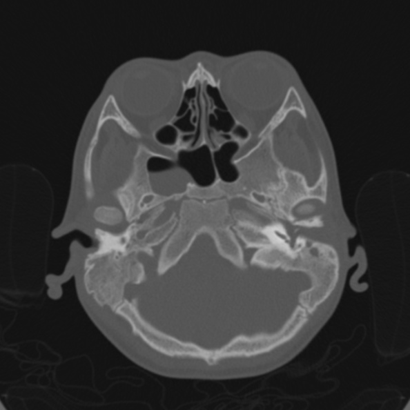 Cerebellar abscess secondary to mastoiditis (Radiopaedia 26284-26413 Axial bone window 41).jpg