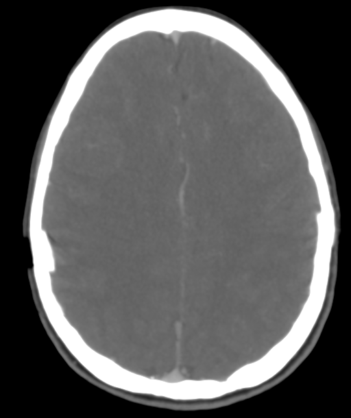 Cerebellar arteriovenous malformation- with hemorrhage (Radiopaedia 35752-37297 B 35).png