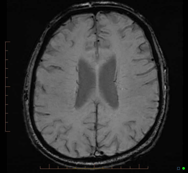 Cerebellar gangliocytoma (Radiopaedia 65377-74422 Axial SWI 38).jpg