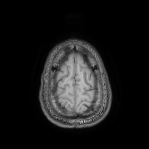 File:Cerebellar hemangioblastoma (Radiopaedia 88055-104622 Axial T1 31).jpg