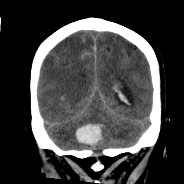 Cerebellar hemorrhage causing obstructive hydrocephalus (Radiopaedia 33989-35207 Coronal non-contrast 40).jpg