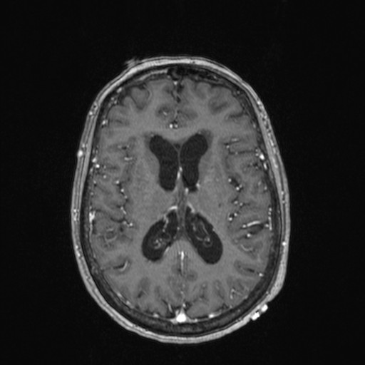 Cerebellar metastases (Radiopaedia 24038-24249 Axial T1 C+ 9).jpg