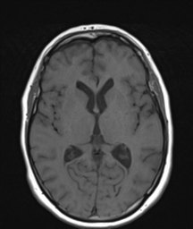File:Cerebellar metastasis (Radiopaedia 54578-60810 Axial T1 20).png