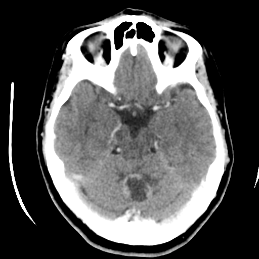 Cerebellar metastasis (cystic appearance) (Radiopaedia 41395-44258 B 19).png