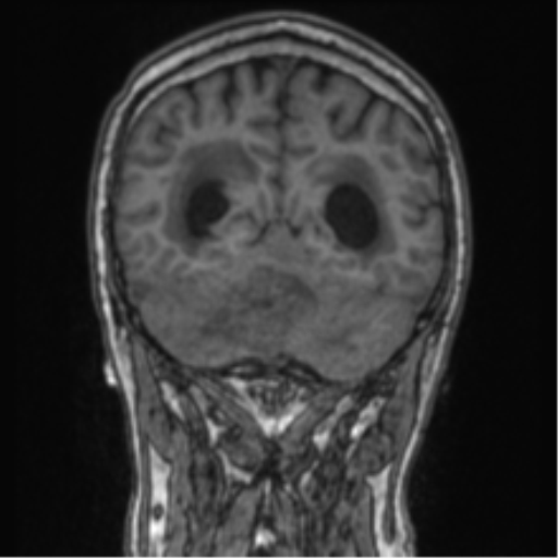 Cerebellar metastasis from lung adenocarcinoma (Radiopaedia 86690-102829 Coronal T1 30).png