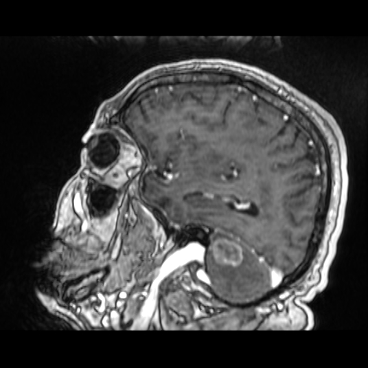Cerebellar metastasis of pulmonary adenocarcinoma, cavernous venous malformation, and developmental venous anomaly (Radiopaedia 85827-101661 Sagittal T1 C+ 32).jpg
