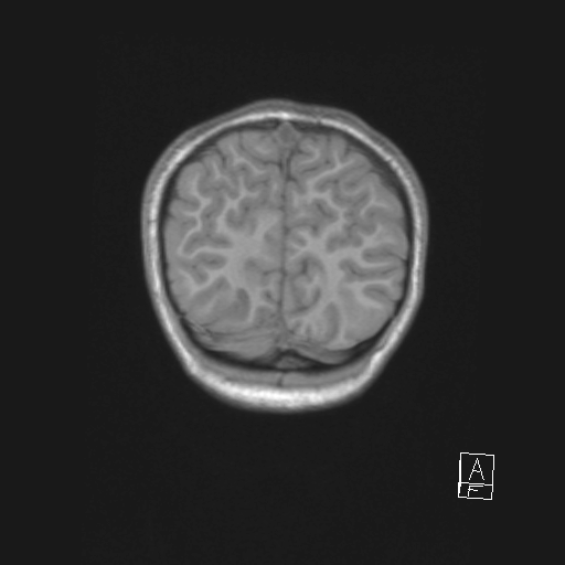 File:Cerebellar stroke (Radiopaedia 32202-33150 Coronal T1 55).png