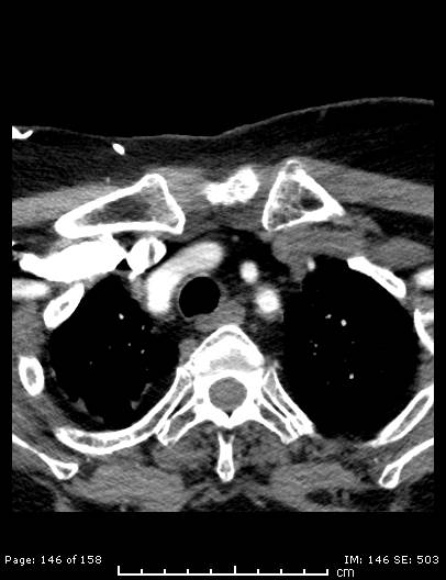 Cerebellar strokes due to intracranial giant cell arteritis (Radiopaedia 68799-78510 CT angiogram 146).jpg