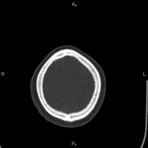 Cerebellopontine angle arachnoid cyst (Radiopaedia 85149-100704 Axial bone window 48).jpg