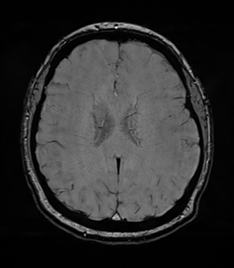 Cerebellopontine angle meningioma (Radiopaedia 48434-53348 Axial SWI 58).png
