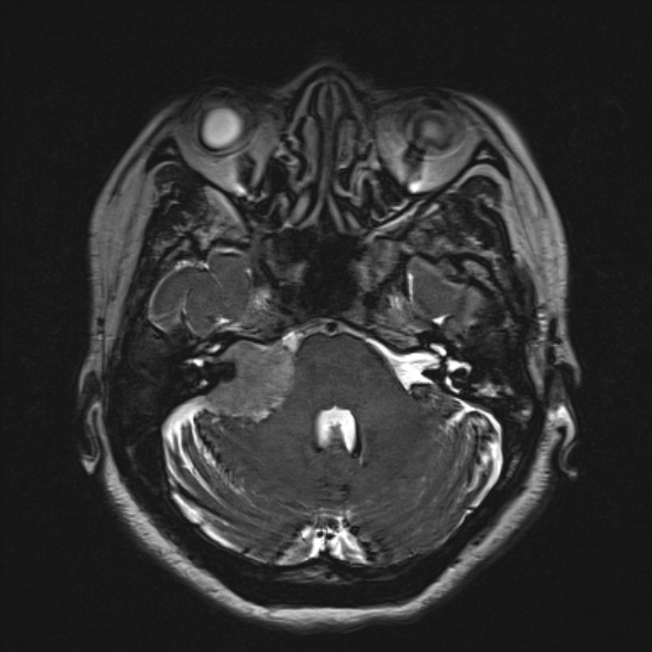 Cerebellopontine angle meningioma (Radiopaedia 53561-59591 Axial 3D volume T2 61).jpg