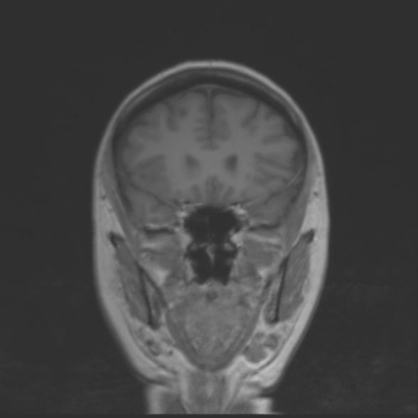 File:Cerebellopontine angle meningioma (Radiopaedia 53561-59591 Coronal T1 8).jpg