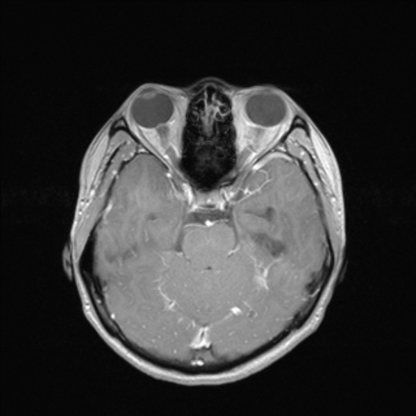 File:Cerebral abscess (Radiopaedia 24212-24478 Axial T1 C+ 24).jpg
