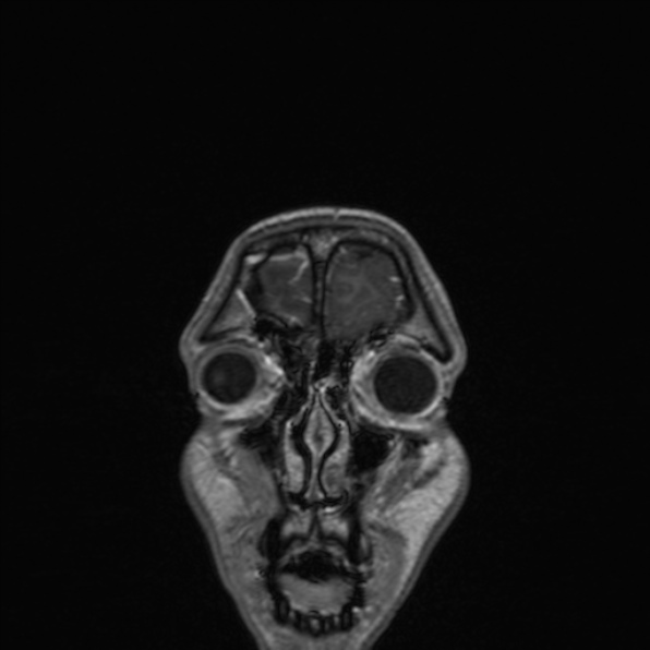 Cerebral abscess (Radiopaedia 24212-24478 Coronal T1 C+ 35).jpg