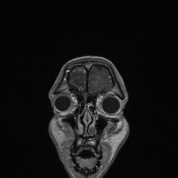 Cerebral abscess (Radiopaedia 24212-24478 Coronal T1 C+ 36).jpg