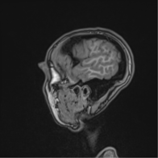 File:Cerebral abscess (Radiopaedia 60342-68009 Sagittal T1 49).png