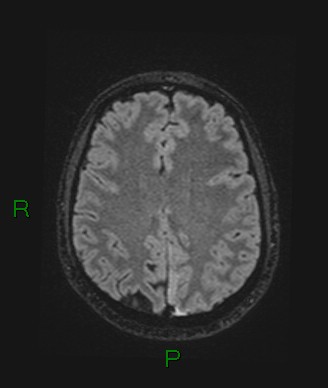 Cerebral abscess and subdural empyema (Radiopaedia 84436-99779 Axial FLAIR 31).jpg