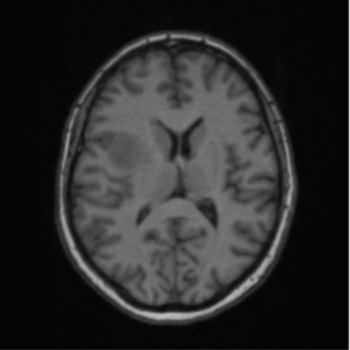 Cerebral abscess from pulmonary arteriovenous malformation (Radiopaedia 86275-102291 Axial T1 43).png