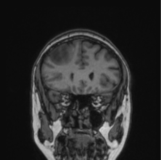 File:Cerebral abscess from pulmonary arteriovenous malformation (Radiopaedia 86275-102291 Coronal T1 65).png