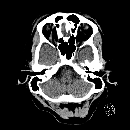 Cerebral abscess with ventriculitis (Radiopaedia 78965-91876 Axial non-contrast 12).jpg