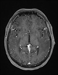 Cerebral amyloid angiopathy-related inflammation (Radiopaedia 58270-65377 Axial T1 C+ fat sat 67).jpg