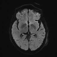 Cerebral amyloid angiopathy-related inflammation (Radiopaedia 74836-85849 Axial DWI 45).jpg