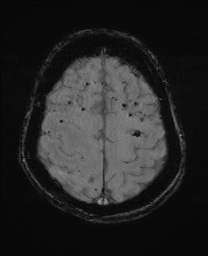 File:Cerebral amyloid angiopathy-related inflammation (Radiopaedia 74836-85849 Axial SWI 56).jpg