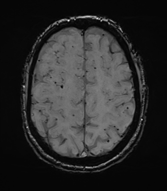 Cerebral amyloid angiopathy (Radiopaedia 46082-50433 Axial SWI 63).png