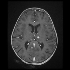 Cerebral and spinal tuberculosis (Radiopaedia 90489-107837 Axial T1 C+ 114).jpg