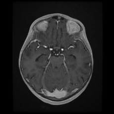 File:Cerebral and spinal tuberculosis (Radiopaedia 90489-107837 Axial T1 C+ 81).jpg