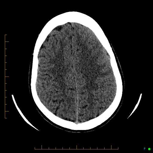 Cerebral arteriovenous malformation (AVM) (Radiopaedia 78162-90706 Axial non-contrast 48).jpg