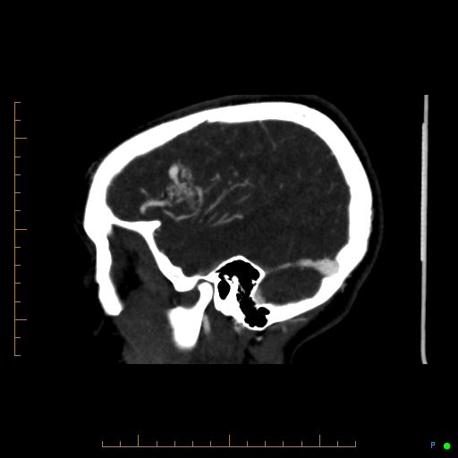 Cerebral arteriovenous malformation (AVM) (Radiopaedia 78162-90706 Sagittal CTA 18).jpg