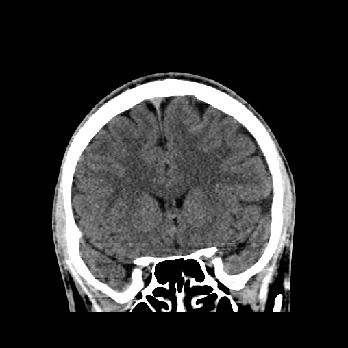 Cerebral arteriovenous malformation (Radiopaedia 61964-70028 Coronal non-contrast 21).jpg