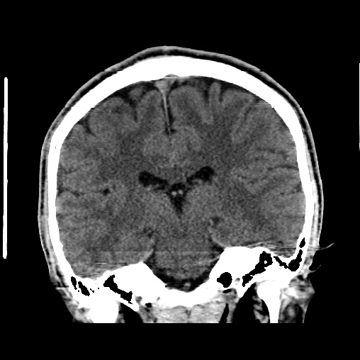 Cerebral arteriovenous malformation (Radiopaedia 61964-70028 Coronal non-contrast 35).jpg