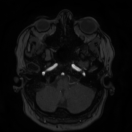 Cerebral arteriovenous malformation (Radiopaedia 74411-85654 Axial MRA 10).jpg