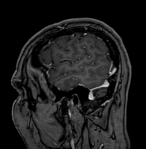 Cerebral arteriovenous malformation (Radiopaedia 74411-85746 Sagittal T1 C+ 13).jpg