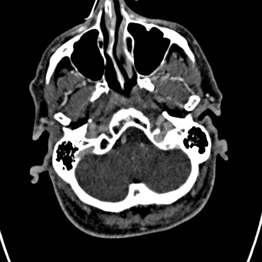 Cerebral arteriovenous malformation (Radiopaedia 78188-90746 Axial C+ delayed 24).jpg
