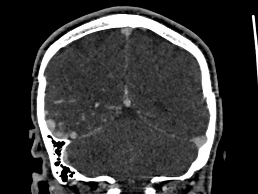 Cerebral arteriovenous malformation (Radiopaedia 78188-90746 Coronal C+ delayed 90).jpg